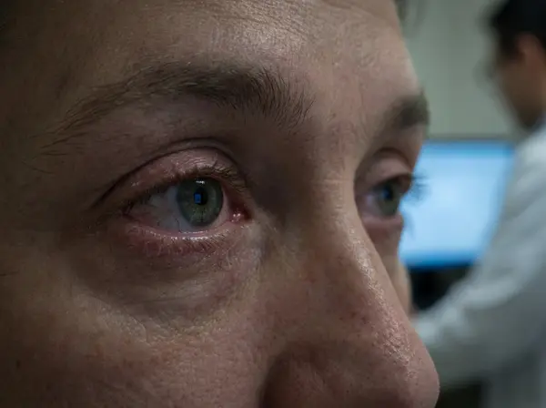 Close-up showing symptoms of digital eye strain including redness and fatigue from prolonged screen use