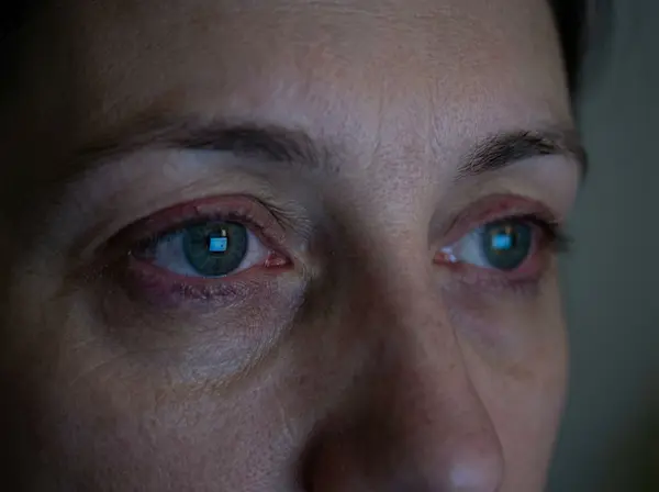 Digital eye strain and computer vision syndrome causing blurry vision in tech workers